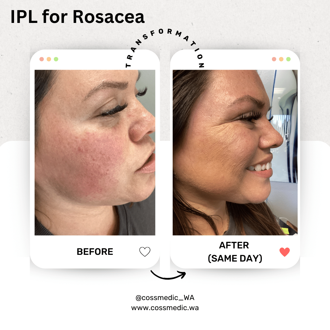 Before and After Image: IPL for Rosacea - right-side