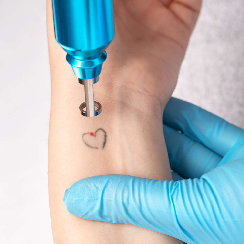 Woman getting a heart tattoo removed from her wrist