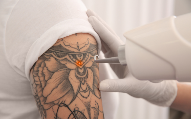 Man having an arm tattoo removed