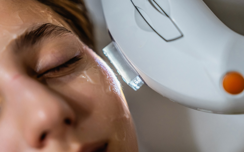 Woman receiving an IPL treatment